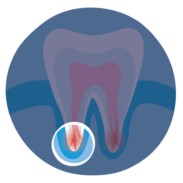 GentleWave Procedure