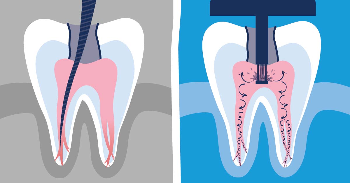 GentleWave Procedure