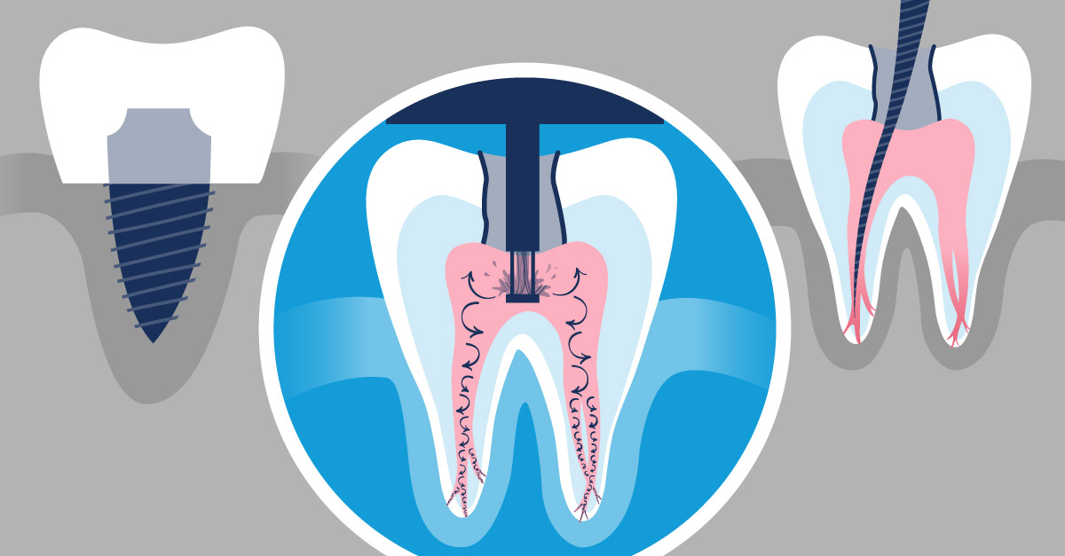 GentleWave Procedure