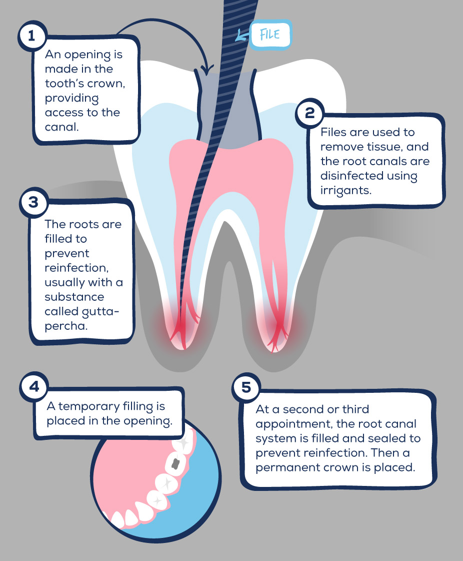 GentleWave Procedure