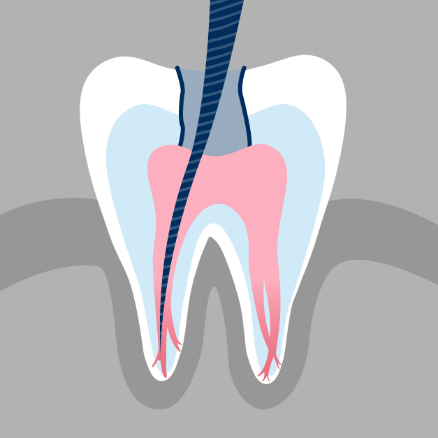 Causes of Root Canals | Repeat Dental Procedures