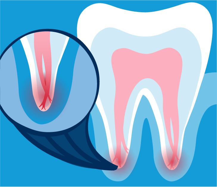 Treating Challenging Root Canal Anatomy
