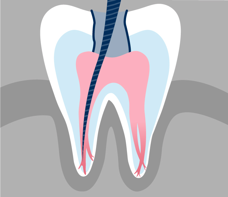 What is Conventional Root Canal Treatment?