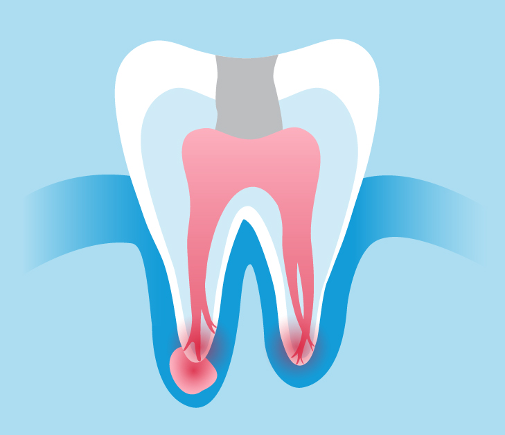Risks of Leaving a Root Canal Infection Untreated