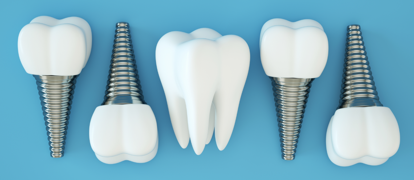 Dental Implants