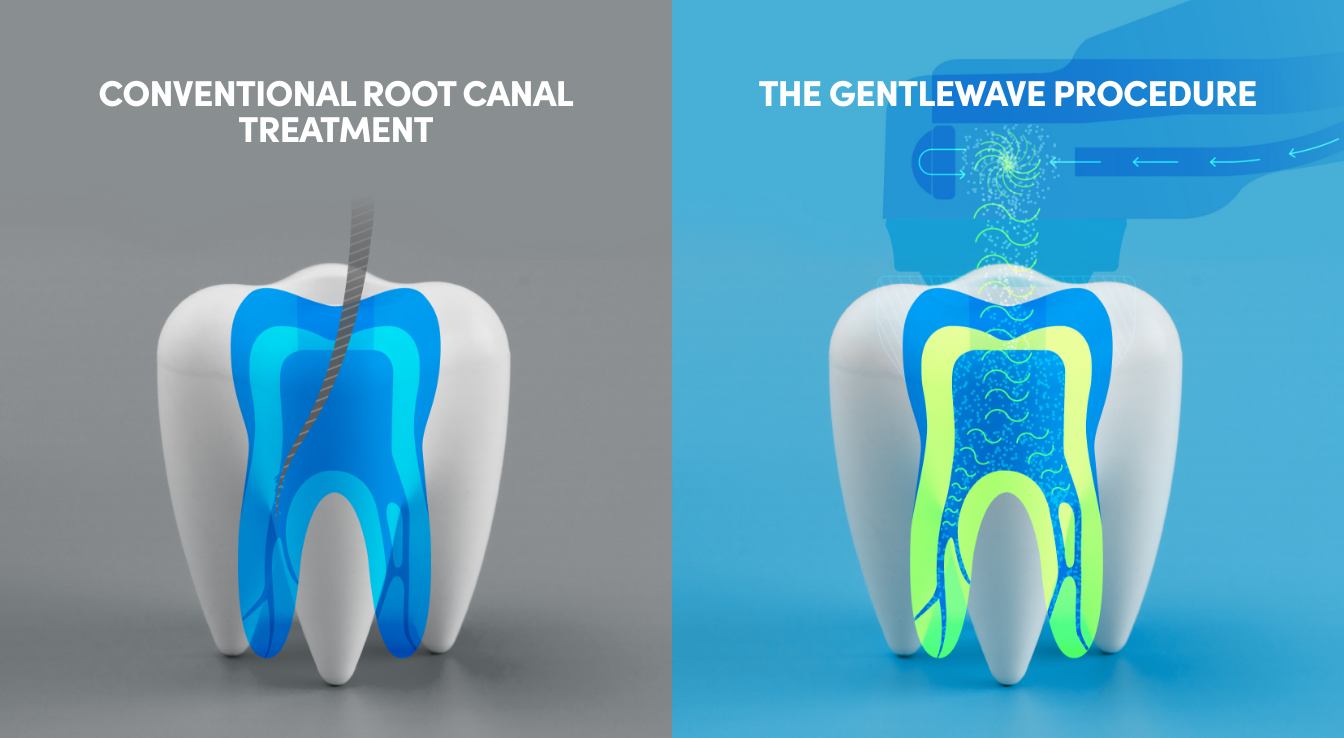 Conventional Root Canal vs. The GentleWave Procedure