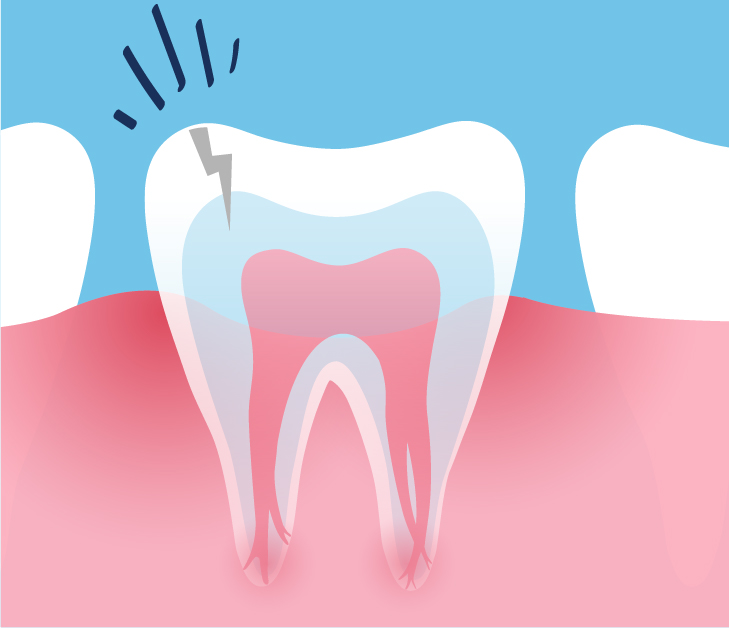 What causes a root canal system infection? 