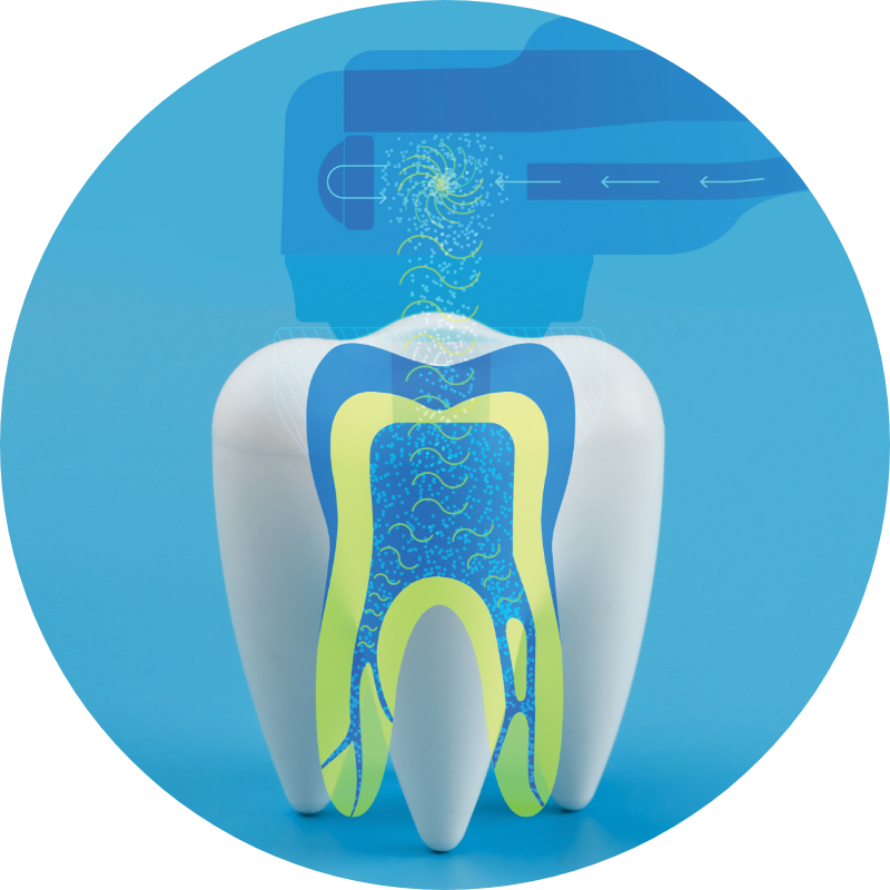 The GentleWave Mechanism of Action: Remove the Infection from the Dentin