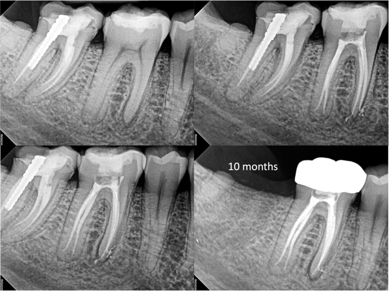 Middle Mesials in MN Molars with 10 Months Healing Evidence