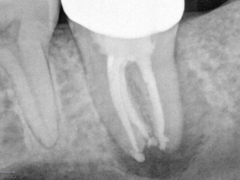 Guarded Pre-Op with Healing Evidence