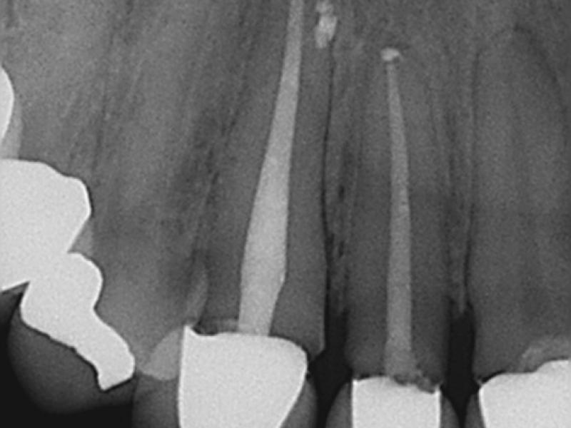 Calcified Canals with 2 Years Healing Evidence