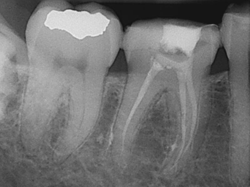 Middle Mesials in MN Molars