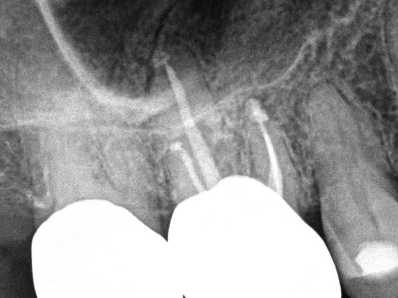 Silver Point Retreatment with Symptomatic Apical Periodontitis