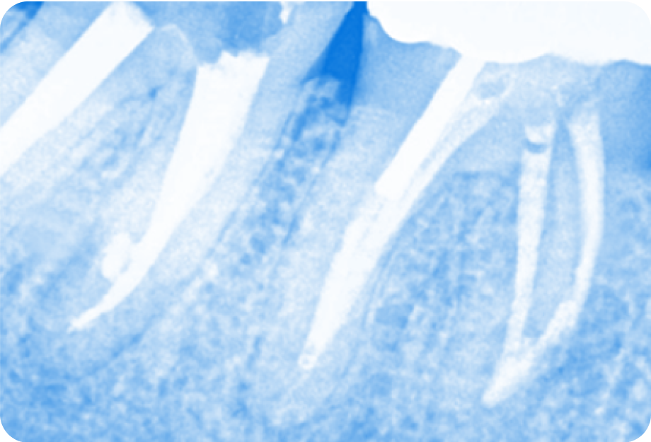 ReTx and Resolution of a Problematic 2nd Molar