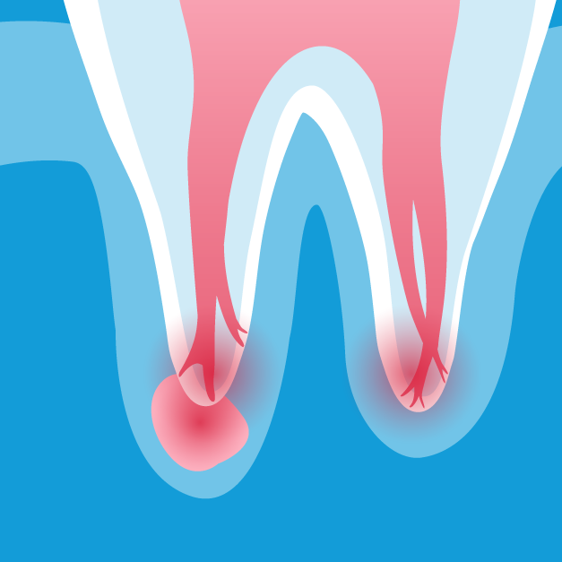 Root Canal