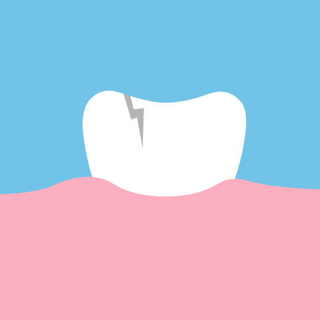 Causes of Root Canals | Damaged Tooth
