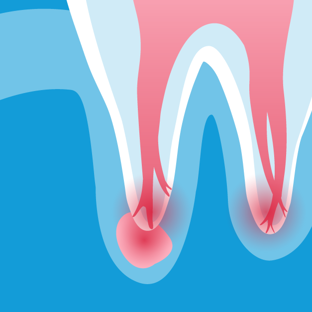 Causes of Root Canals | Deep Decay