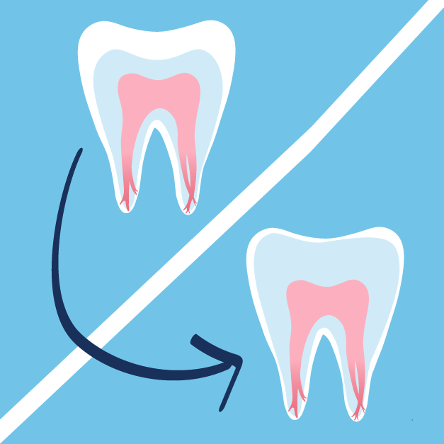 Causes of Root Canals | Root Resorption
