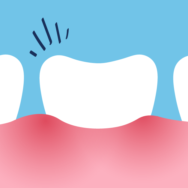 Causes of Root Canal System Infection