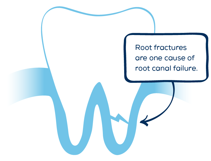 Causes of a Root Canal Failure