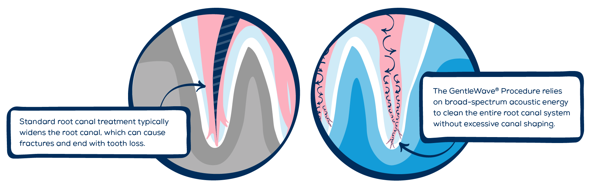 Compare Standard RCT with the GW Procedure