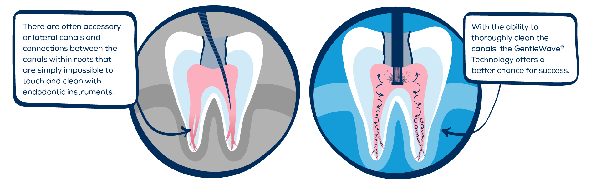 Standard RCT Compared to the GW Procedure