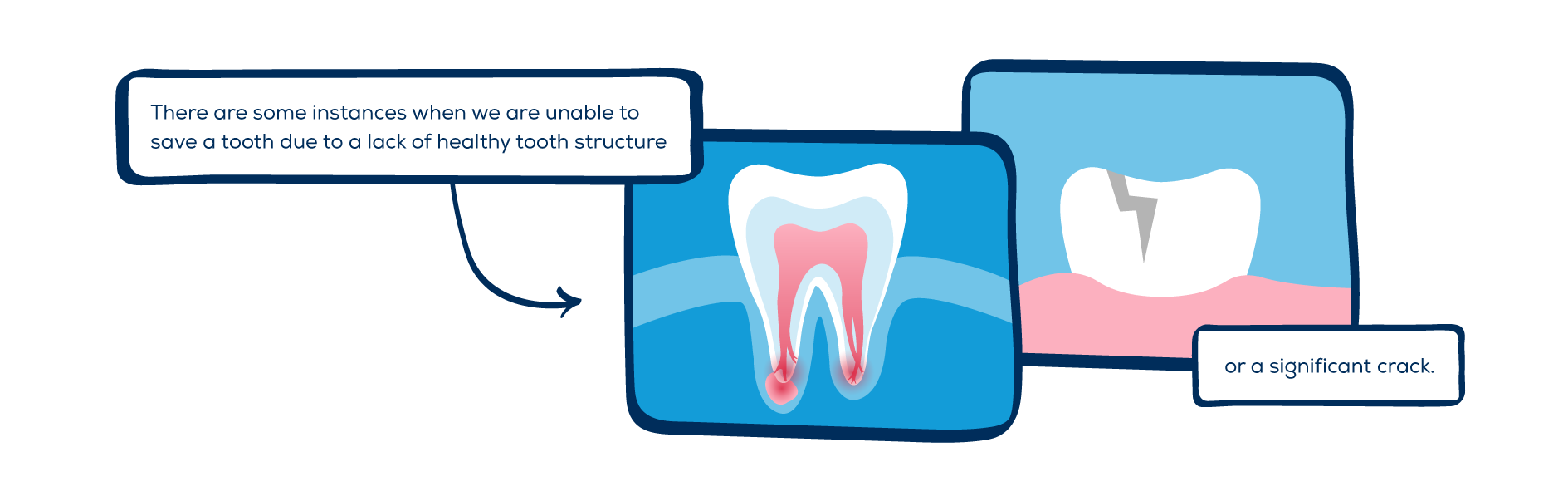 Root Canal Treatment Options