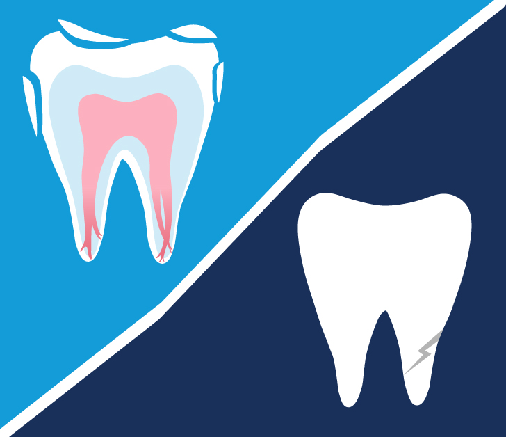 What Causes a Root Canal Infection?