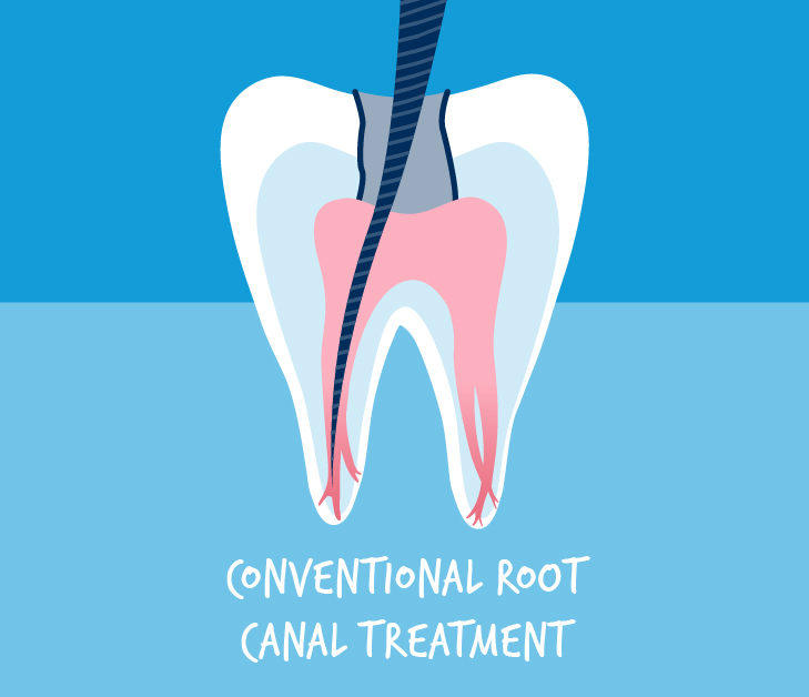 Conventional Root Canal Treatment