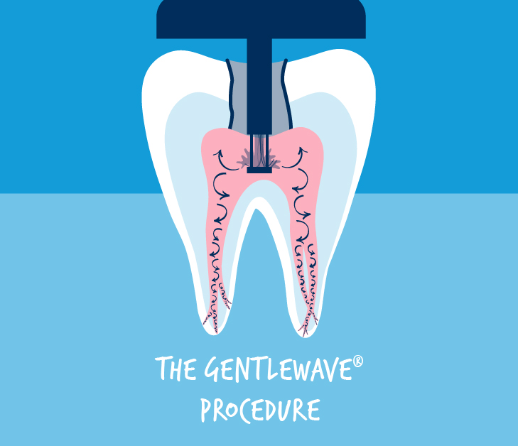 The GentleWave Procedure