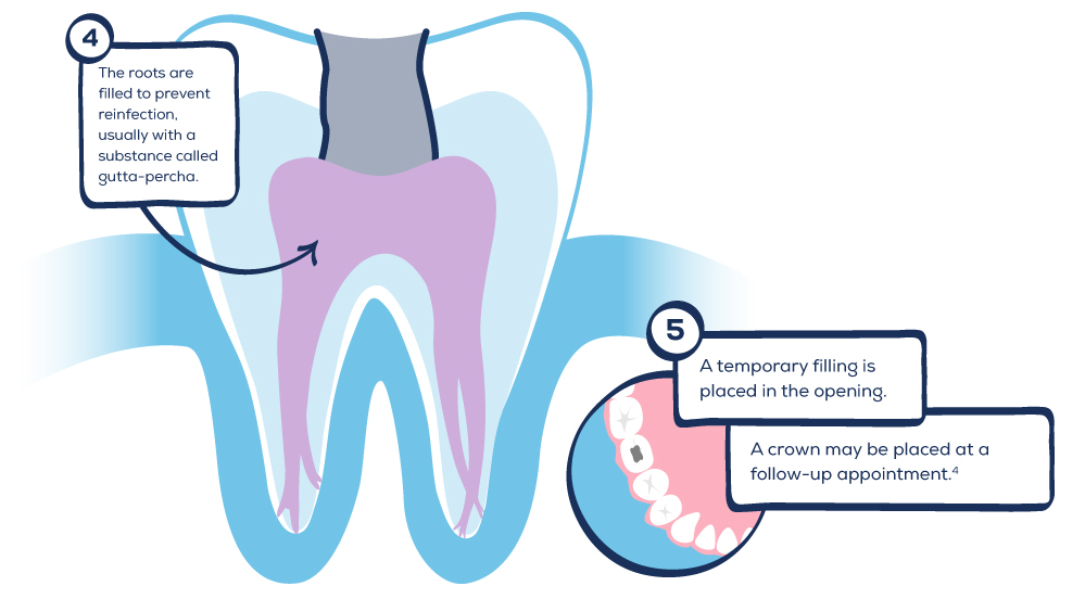 how long does a canine root canal take