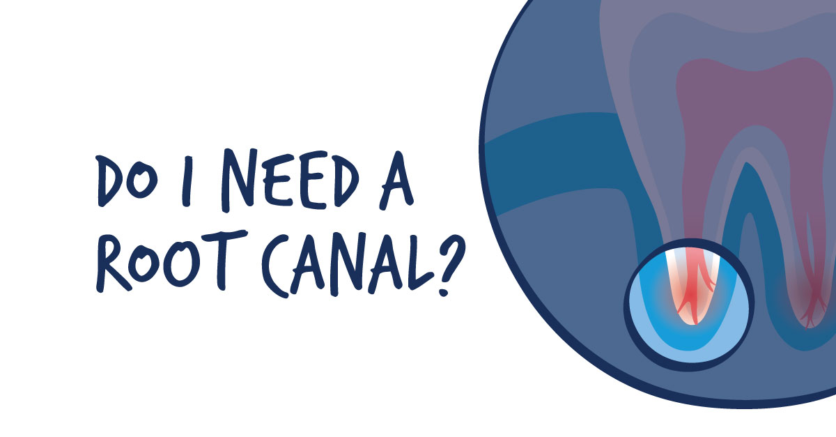 Do Cavities Cause Root Canal System Infections?
