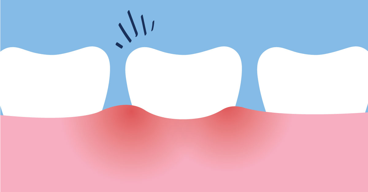 Pulpitis & Root Canal System Infections in Wisdom Teeth