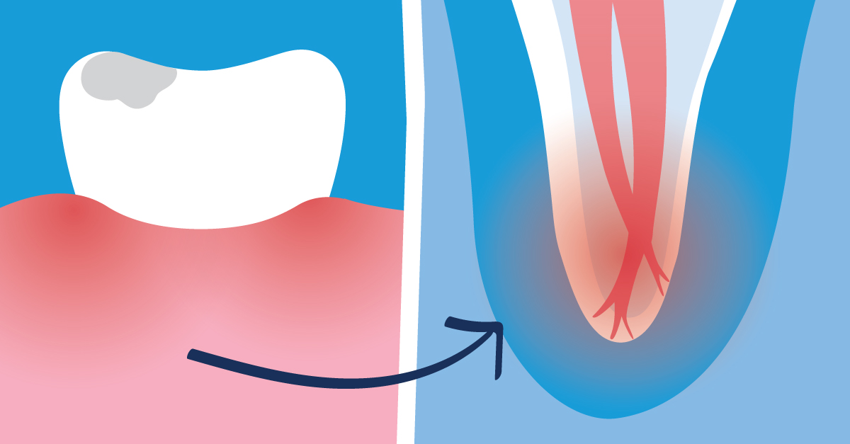 The Main Causes of Root Canal Infection