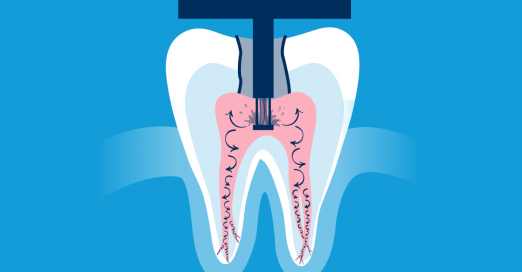 The GentleWave Procedure Root Canal Treatment 