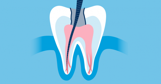 history of root canals