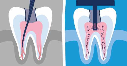 root canal treatment 