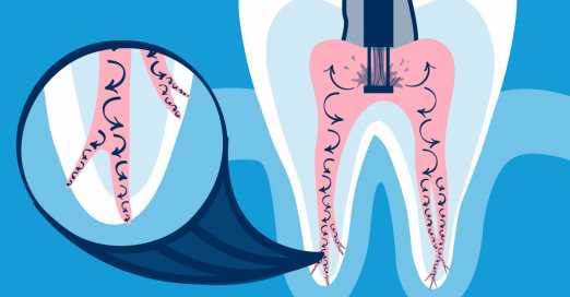 root canal alternative | GentleWave Procedure